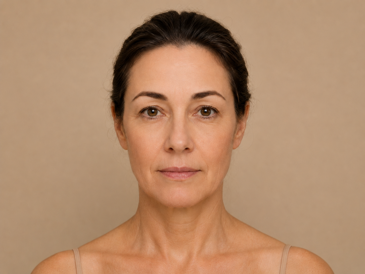 After botox treatment result